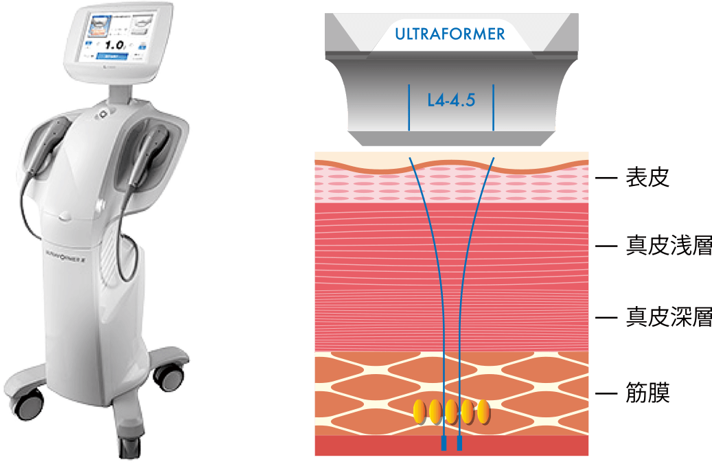 医療用HIFUウルトラフォーマ―Ⅲ