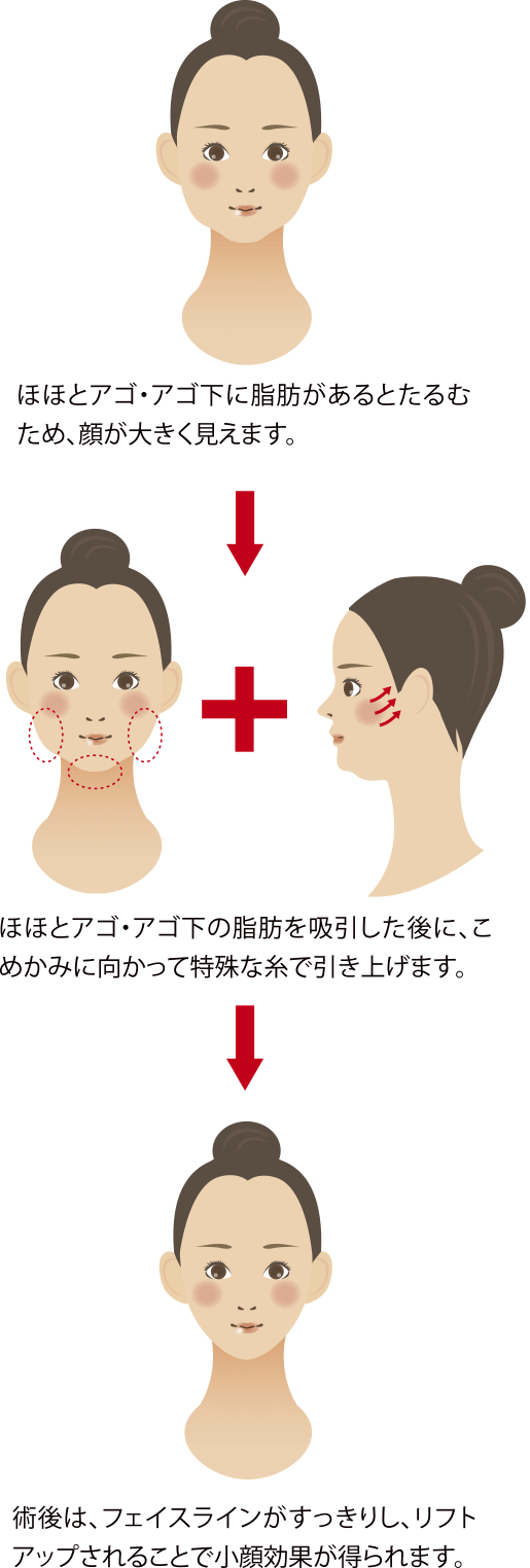 ほほアゴ脂肪吸引+糸リフトアップ