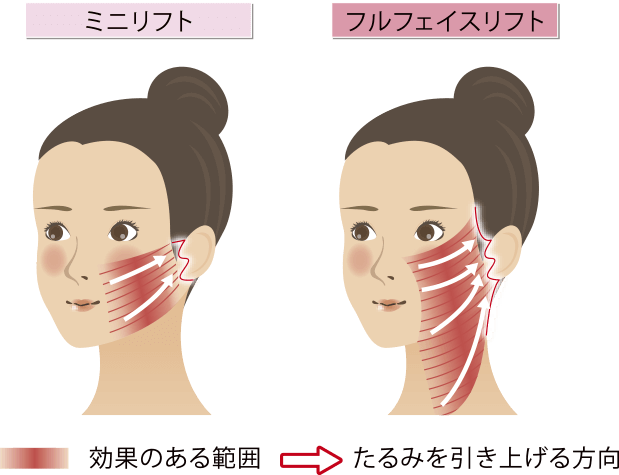 フェイスリフト