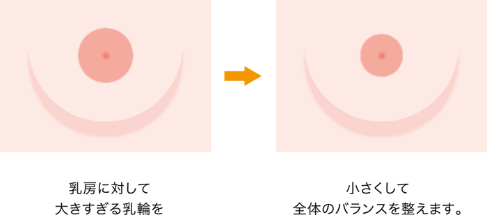 乳輪縮小