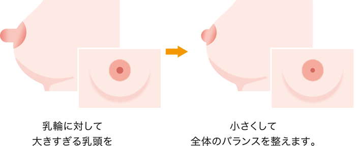 乳頭縮小