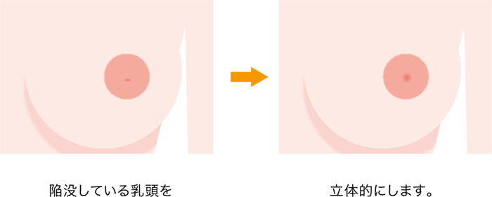 陥没乳頭
