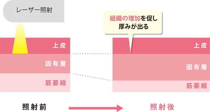 インティマレーザー照射前・照射後