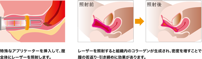 インティマレーザーでの膣引き締め治療（PC版）