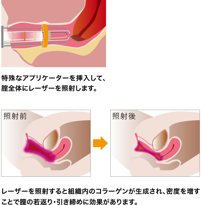 インティマレーザーでの膣引き締め治療（SP版）