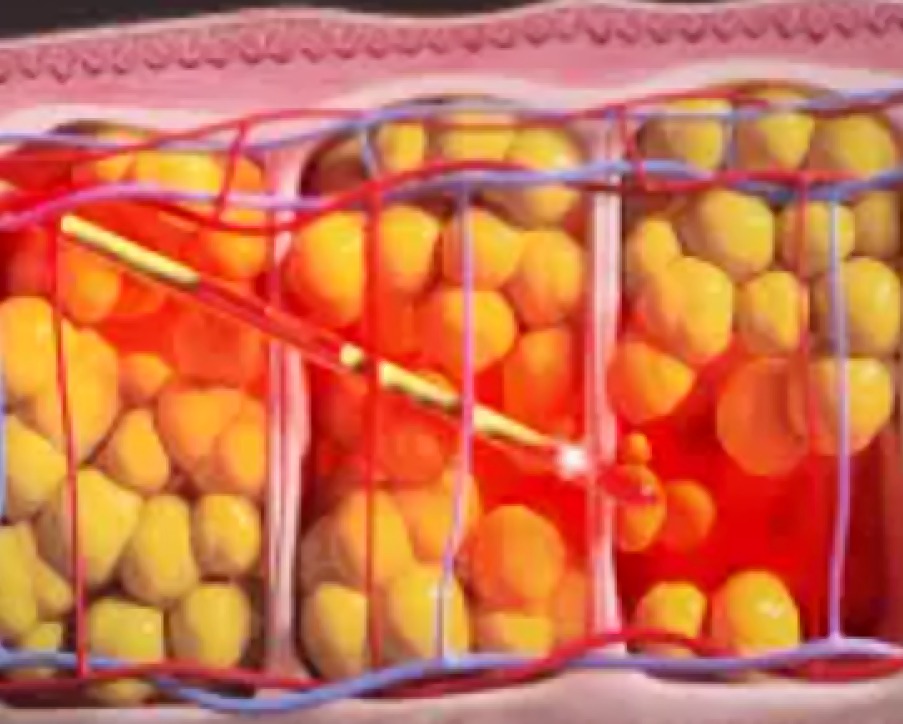 ダイオードレーザー