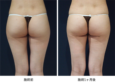 ダイオードレーザーによる脂肪吸引症例その１ | 施術前から１ヶ月後の経過観察