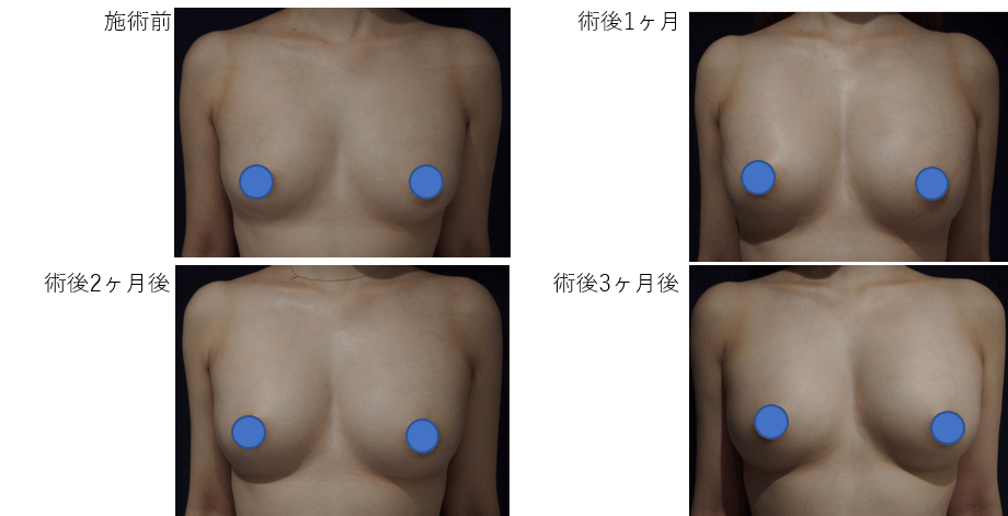 コンデンスリッチ豊胸のビフォー・アフター症例その１ | 施術前から１ヶ月後、２ヶ月後、３ヶ月後の経過観察(PC版)