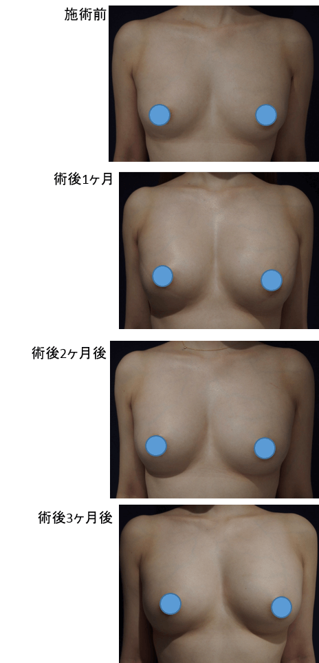 コンデンスリッチ豊胸のビフォー・アフター症例その１ | 施術前から１ヶ月後、２ヶ月後、３ヶ月後の経過観察(SP版)
