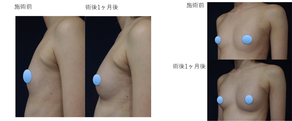 コンデンスリッチ豊胸のビフォー・アフター症例その２ | 施術前から１ヶ月後の経過観察(PC版)