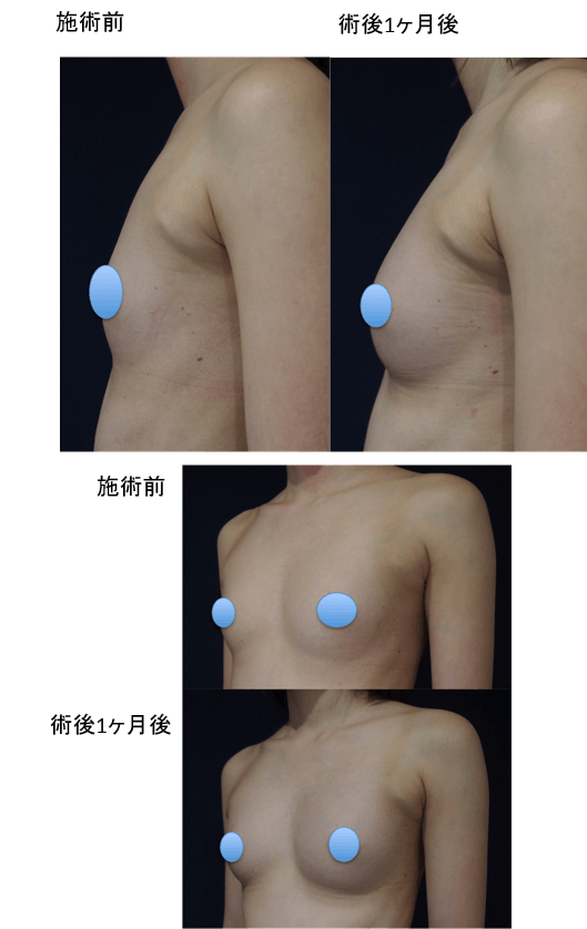 コンデンスリッチ豊胸のビフォー・アフター症例その２ | 施術前から１ヶ月後の経過観察(SP版)