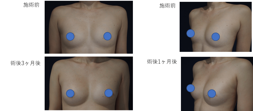 コンデンスリッチ豊胸のビフォー・アフター症例その３ | 施術前から１ヶ月後、３ヶ月後の経過観察(PC版)
