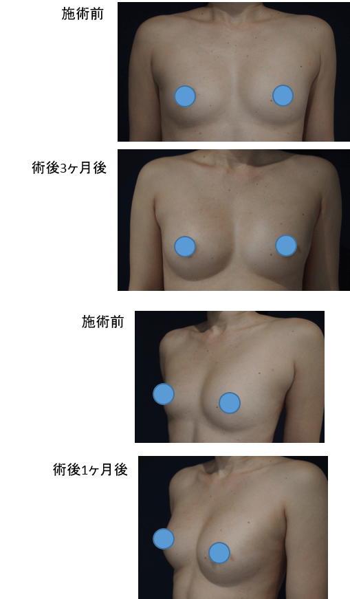 コンデンスリッチ豊胸のビフォー・アフター症例その３ | 施術前から１ヶ月後、３ヶ月後の経過観察(SP版)