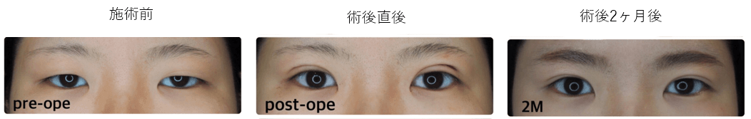 両目3点止めエターナルメソッド