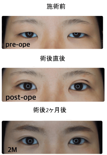 両目3点止めエターナルメソッド