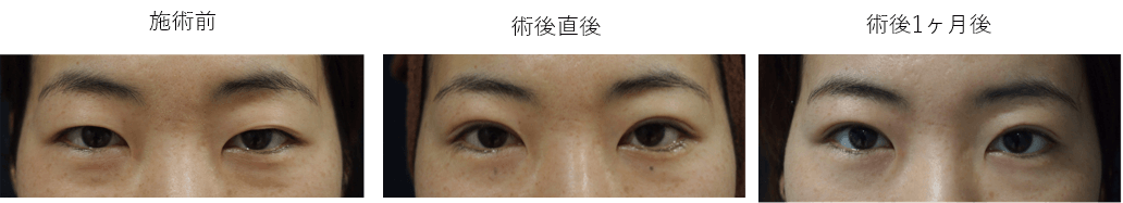 両目3点止めエターナルメソッド