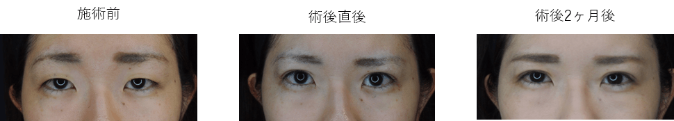 ウェストくびれ形成セット