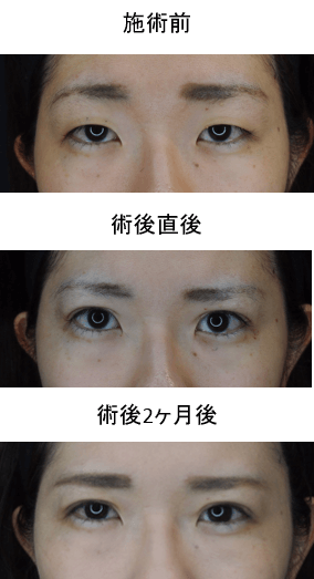 ウェストくびれ形成セット