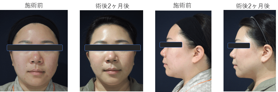 ダイオードレーザーによる脂肪吸引症例その２ | 施術前から２ヶ月後の経過観察(PC版)
