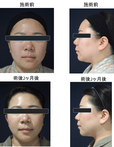 ダイオードレーザーによる脂肪吸引症例その２ | 施術前から２ヶ月後の経過観察(SP版)