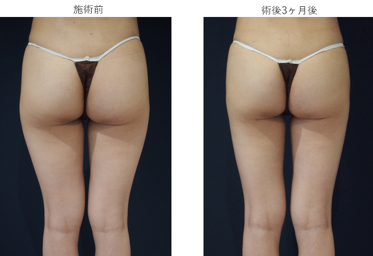 ダイオードレーザーによる脂肪吸引症例その４ | 施術前から３ヶ月後の経過観察