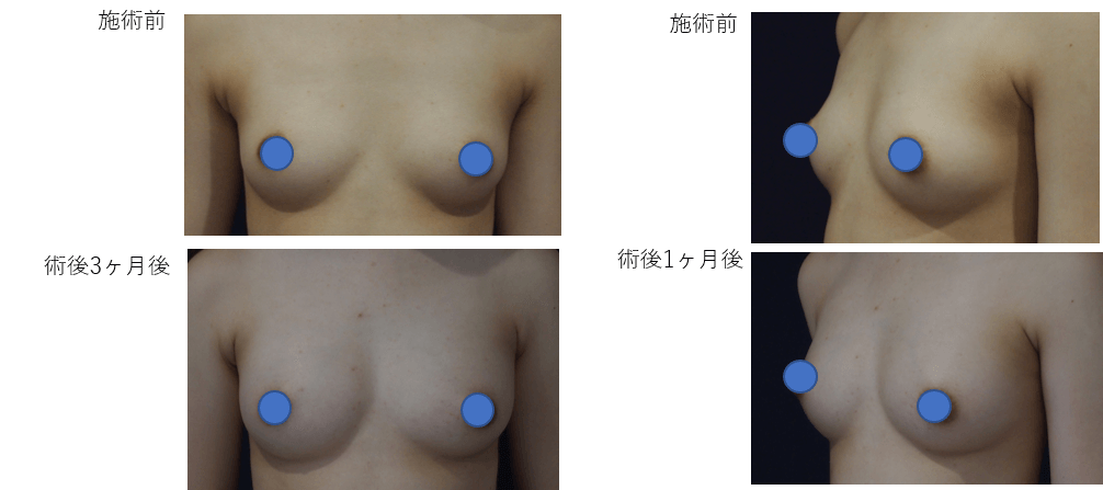 通常脂肪＋エクソソーム同時注入豊胸術のビフォー・アフター症例その１ | 施術前から１ヶ月後、２ヶ月後、３ヶ月後の経過観察(PC版)