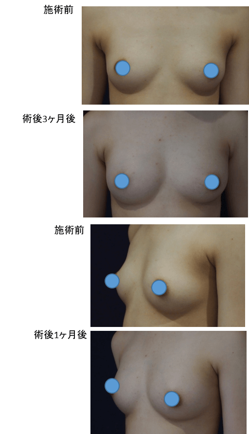 通常脂肪＋エクソソーム同時注入豊胸術のビフォー・アフター症例その１ | 施術前から１ヶ月後、２ヶ月後、３ヶ月後の経過観察(SP版)