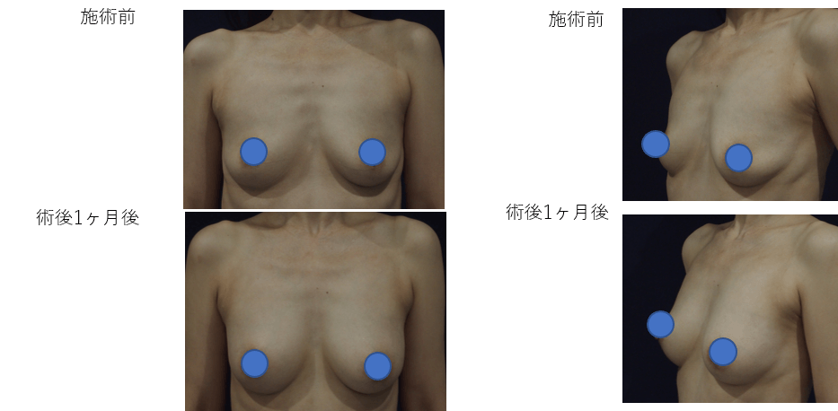 ダイオードレーザー脂肪注入＋エクソソーム同時注入豊胸術症例その１ | 施術前から１ヶ月後の経過観察(PC版)