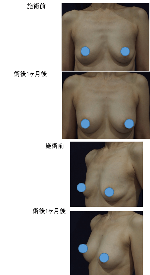 ダイオードレーザー脂肪注入＋エクソソーム同時注入豊胸術症例その１ | 施術前から１ヶ月後の経過観察(SP版)