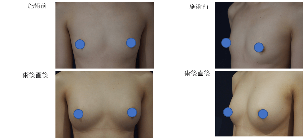 1回目：コンデンスリッチ豊胸、2回目：LipoLife豊胸術症例その１ | 施術前から施術直後の経過観察(PC版)
