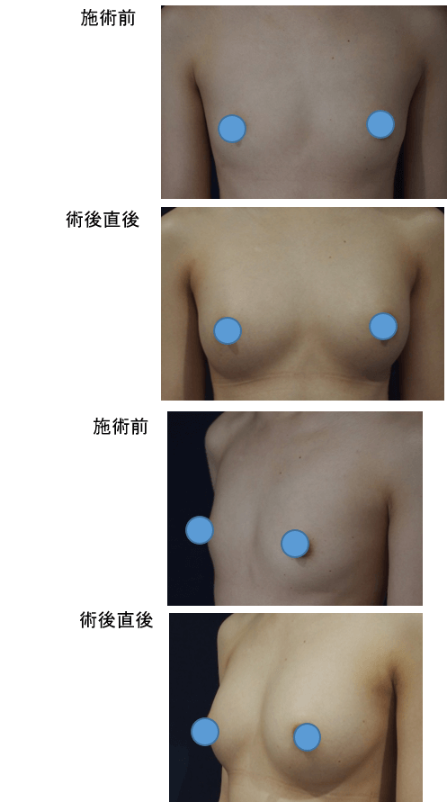 1回目：コンデンスリッチ豊胸、2回目：LipoLife豊胸術症例その１ | 施術前から施術直後の経過観察(SP版)