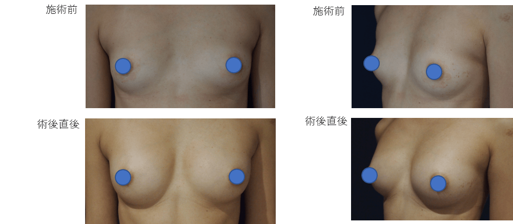 1回目：コンデンスリッチ豊胸、2回目：通常脂肪注入豊胸術症例その１ | 施術前から施術直後の経過観察(PC版)