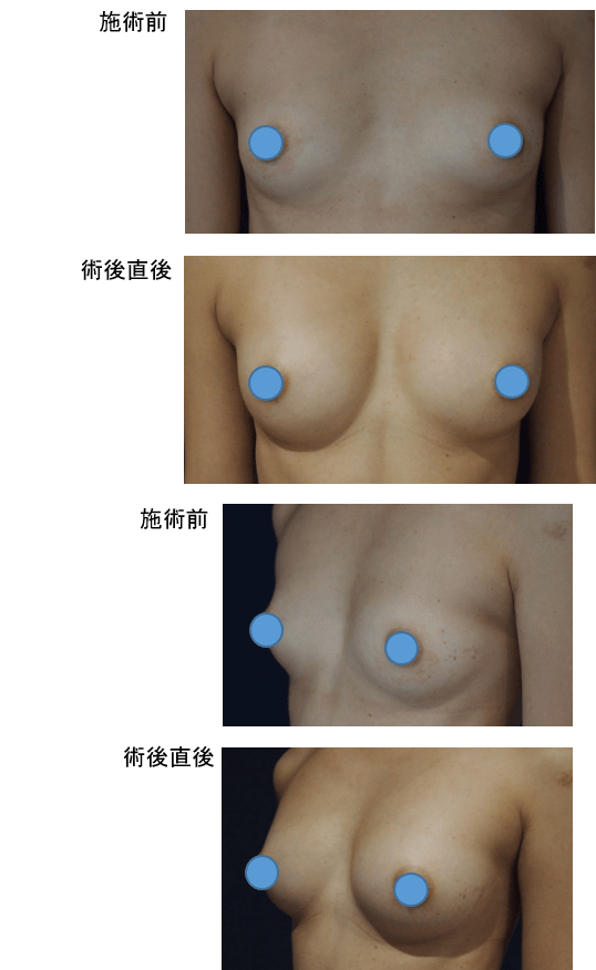 1回目：コンデンスリッチ豊胸、2回目：通常脂肪注入豊胸術症例その１ | 施術前から施術直後の経過観察(SP版)