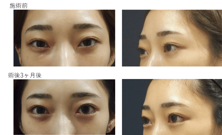 目尻切開＋目尻靭帯移動＋グラマラスライン形成(経結膜)