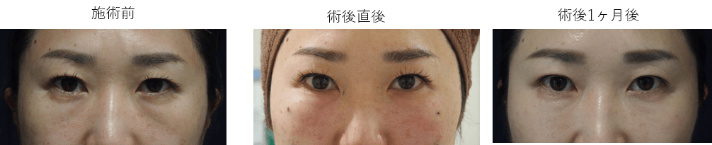 目の下脂肪注入