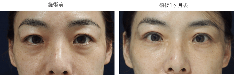 目の下脂肪注入