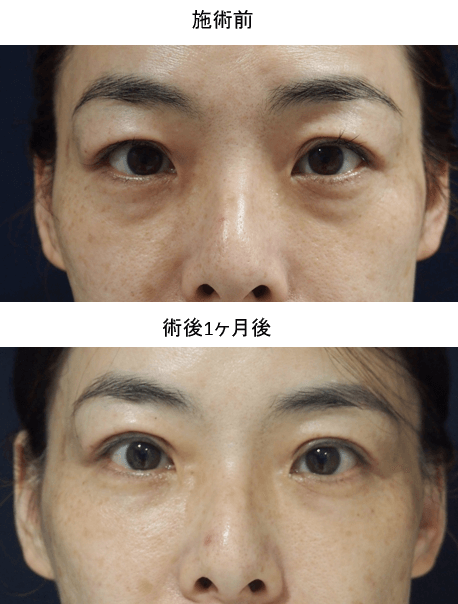 目の下脂肪注入