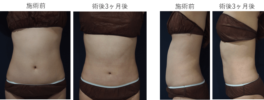 ダイオードレーザーによる脂肪吸引症例その３ | 施術前から３ヶ月後の経過観察(PC版)
