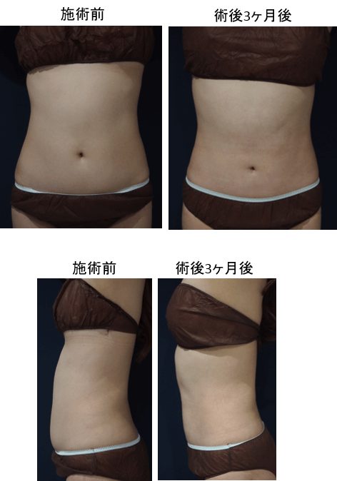 ダイオードレーザーによる脂肪吸引症例その３ | 施術前から３ヶ月後の経過観察(SP版)