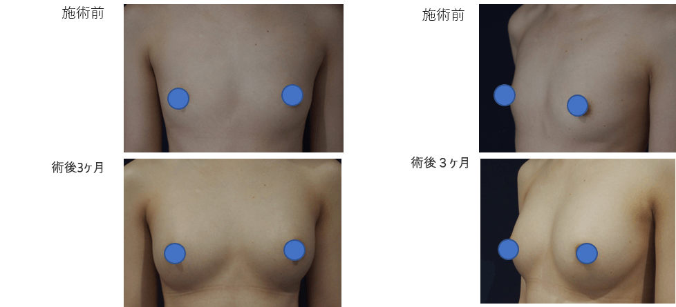 ダイオードレーザー脂肪注入豊胸術症例その１ | 施術前から施術直後の経過観察(PC版)