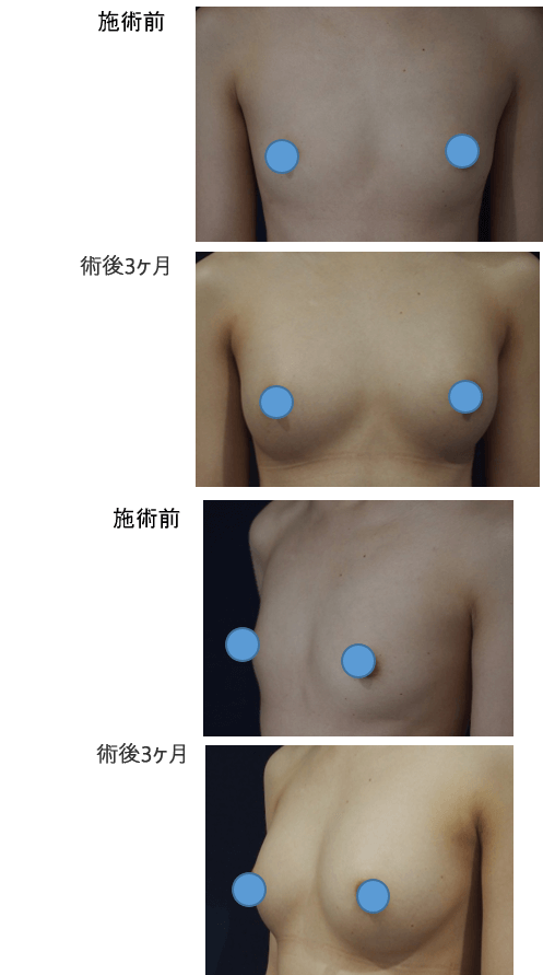 ダイオードレーザー脂肪注入豊胸術症例その１ | 施術前から施術直後の経過観察(SP版)
